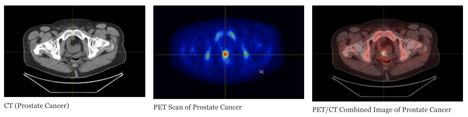 PET Scanning For Prostate Cancer